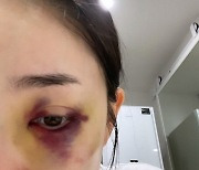 박은영, '골때녀' 훈련 중 충돌사고 "밤탱이 왼쪽 눈"
