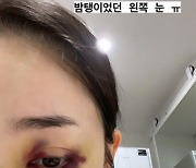 '골때녀' 박은영, 시퍼렇게 멍든 눈..'부상투혼'