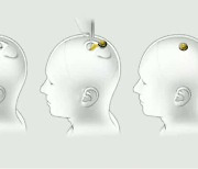 머스크의 뉴럴링크, 사람 뇌에 칩 이식 실험
