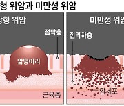 20~30대 공격 '악성 위암' 어떻게 자라날까?