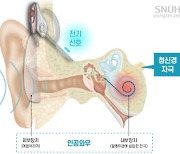 분당서울대병원 이비인후과 청각재활센터 인공와우 이식 수술 1000례 달성