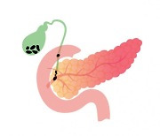 "담석 있으면 췌장암 발생률 6배 ↑" (연구)