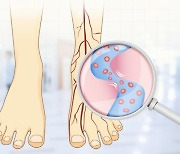 당뇨발 상처 2~3주만 방치해도 절단 위험 높아져 주의해야