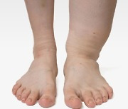 퉁퉁 부은 다리가 그대로 굳는다? '림프부종'의 위험성
