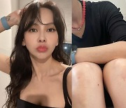 '레이먼킴♥' 김지우, 상처 가득한 다리.."차 긁어먹고 일진 엉망진창"