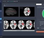 제이엘케이 AI 뇌경색 분석 솔루션, 태국 허가 획득