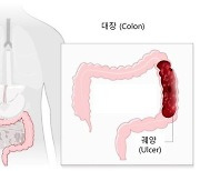 대장암 유발하는 '궤양성 대장염' 10년 새 4.8배