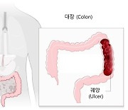 '궤양성대장염' 환자 10년새 5배.."조기치료로 대장암 막아야"