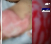 뜨거운 물 부은 10살..가해자 부모 "애들끼리 놀다 그런 건데"