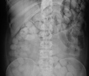 배속에 동그란 비닐봉지 115개..마약 밀수범의 충격 'X-ray'