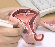 "자궁내막증 환자 5년간 48% 증가..저출산·만혼 영향"