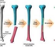 부러진 뼈, 3D 프린팅 기술로 감쪽같이 맞춘다
