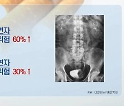 [쿠키건강뉴스] 흡연자 방광암 위험 60% 높아.."혈뇨 보이면 원인 검사"