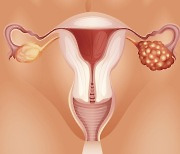 여성암으로 사망률 높은 난소암, 최근 발병률 증가하고 있어