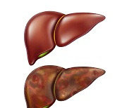 간세포 파괴되는 건 같지만.. A·B·C형 간염 차이는?