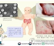 경기지역 '수족구병' 급증..지난주 예년 대비 10배 이상