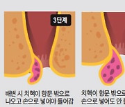 항문에 콩알만 한 덩어리가.. 나는 치핵 '몇 단계'?