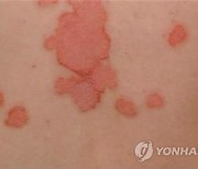 미국 FDA, 판상 건선 치료제 조라이브 승인