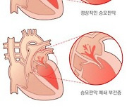 특정 유형의 승모판막 역류증 환자, 수술 후 생존율 낮다