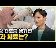 [약손+] 통합치과⑧ 구강 건조증 생기면 치과 치료는?