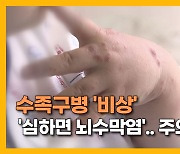 [자막뉴스] 수족구병 비상 '심하면 뇌수막염'