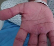 프랑스서 확진자와 한 침대 쓴 반려견 원숭이두창 감염