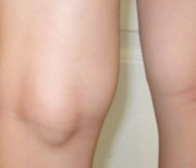무릎 뒤쪽에 혹이 생기는 이 질환은 무엇?
