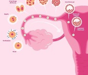 '여성암 사망률 1위' 난소암, 복강 내 항암제 직접 주입하는 새 치료 전략 제시