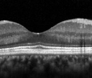망막 황반부 '신경섬유층'두께 얇으면 치매 위험 증가