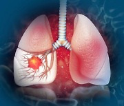 [건강in] 폐암 방사선 치료 때 방사선량 노출 늘리면 심방세동 15배