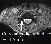 중심경추협착증 새 진단법 개발