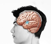 [건강in] "파킨슨병 뇌심부자극술 장기적 안전·효과 높다"
