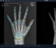 뷰노, AI 골연령 판독 보조 솔루션 대만 인증 획득
