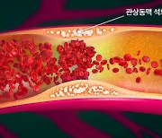 '관상동맥 석회화'되면 콩팥 기능 더 빨리 악화된다