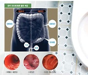 새빨간 혈변은 치질 때문? 그보다 더 '위험한' 병일 수도