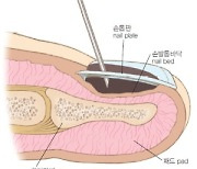 [의학칼럼] 발톱 밑에 멍이 들었다… 치료해야 할까?