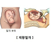 "제왕절개 분만 직후 모자 간 피부접촉 중요"