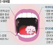 놔두면 낫는다? 조직검사 받아야 하는 '구내염' 모양은…