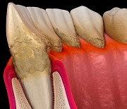 잇몸 붓고 피 철철...'치주염' 일으키는 세균 제거하려면