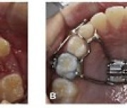 성장기 주걱턱 치료… 치아 안뽑고 교정한다