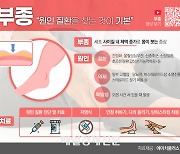 신발이 작아졌거나 반지가 꽉 낀다면 ‘부종’의심을