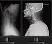 딥노이드, 척추부위 의료영상 AI '딥스파인' 식약처 인증 획득