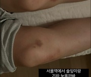 “무릎에 온통 멍” 유깻잎 딸… 무슨 일이야? '깜짝'