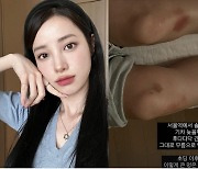 유깻잎, 멍투성이 부상 안타까워…"이렇게 큰 멍 처음"