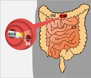 젊은층도 위협하는 대장암 … 식단 관리하고 금주·금연해야