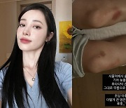 '돌싱' 유깻잎, 서울역에서 이런 봉변을 당하다니…피멍 든 다리 공개