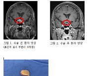 86세 고령 환자, 눈썹 위 최소침습 수술로 뇌종양 제거 성공