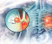 평생 담배 한 번 안 피워도… ‘이것’ 때문에 폐암