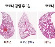 서울대병원 연구팀 "코로나·폐렴 흡입형 치료제 물질 확인"