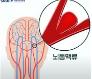 머릿속 시한폭탄 뇌동맥류, 사전에 증상과 수술법 파악하는 것이 중요